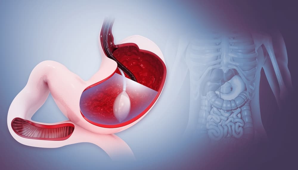 Gastric Balloon Procedure